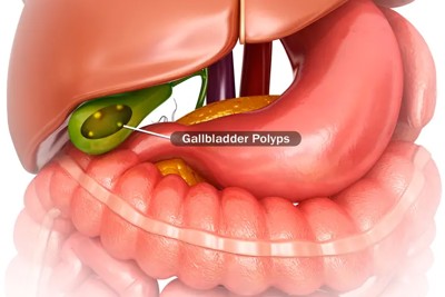 Polyps